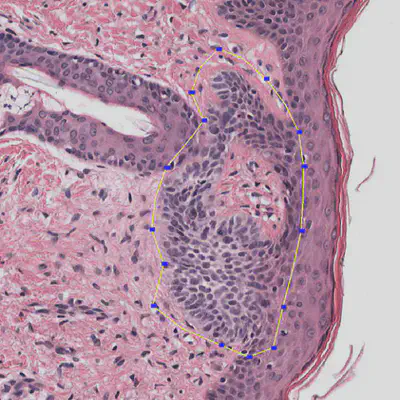 Annotation of a Basal Cell Carcinoma, a skin cancer with, typically, good prognosis.