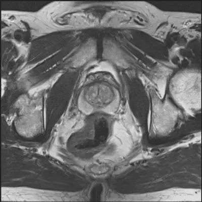 Transversal slide through the prosate in a T2-weighted MRI sequence.